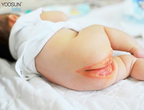 kem bôi dị ứng bỉm