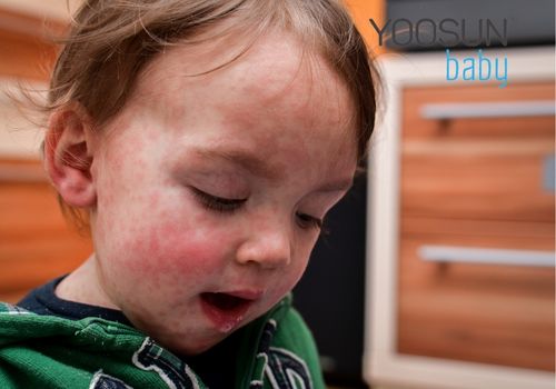 trẻ bị dị ứng trứng gà phải làm sao