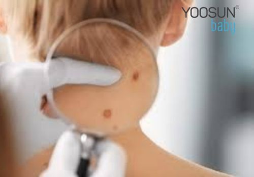 trẻ sơ sinh nổi mụn nước
