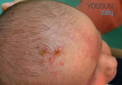 trẻ sơ sinh bị nổi mụn nước ở mặt