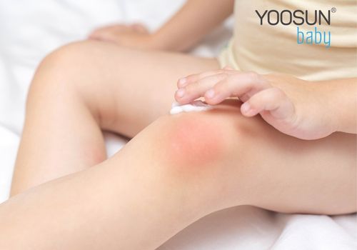 bé bị nổi mụn nước
