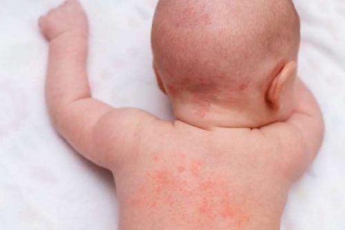 trẻ bị dị ứng trứng gà phải làm sao