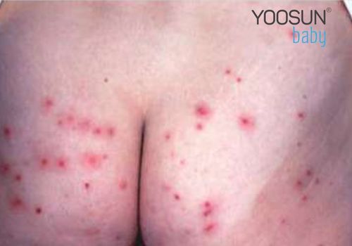 trẻ nổi mụn nước