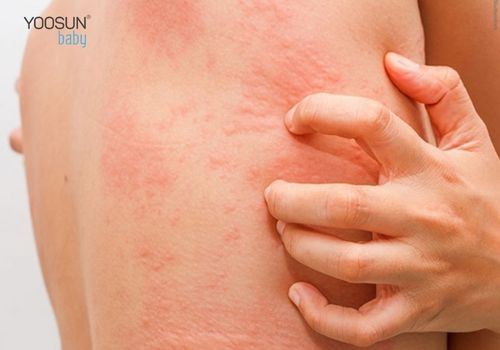 bị dị ứng sầu riêng
