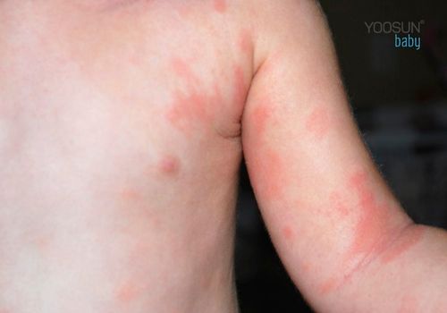 dị ứng cá hồi ở trẻ em