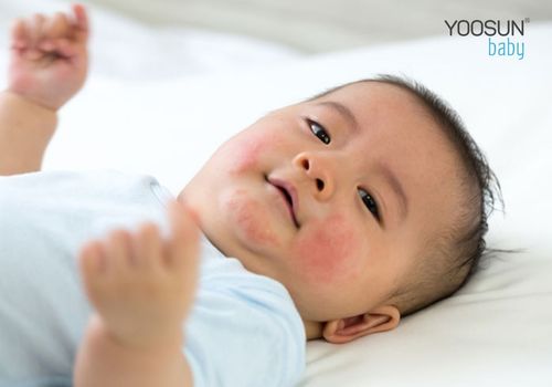 dị ứng gió lạnh