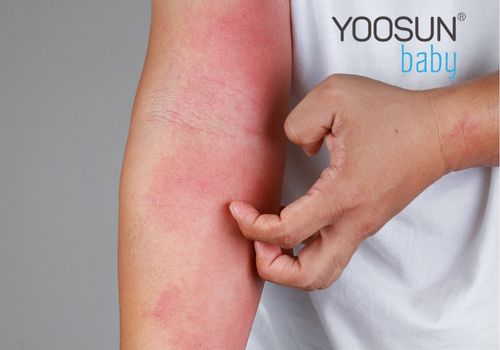 dị ứng tôm cua