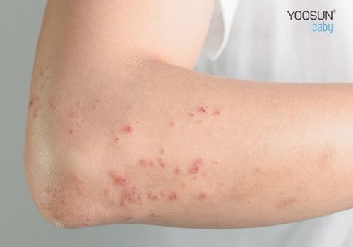 dị ứng với nước mưa