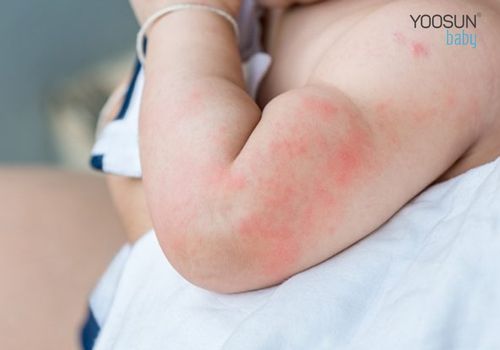 dị ứng với nước