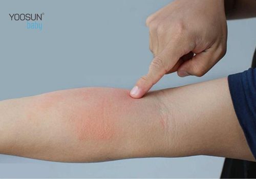 dị ứng với sầu riêng