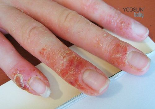dị ứng xà phòng giặt