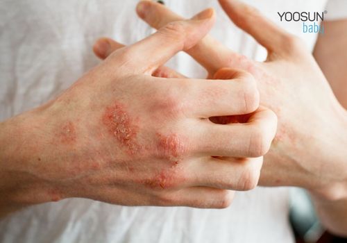 dị ứng xà phòng
