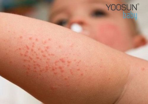 mụn nước ở trẻ sơ sinh