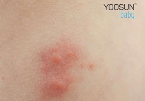 vết muỗi đốt