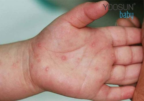 trẻ bị nổi mụn nước khắp người