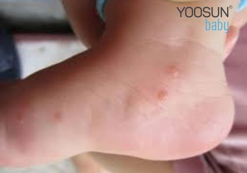 trẻ bị nổi mụn nước