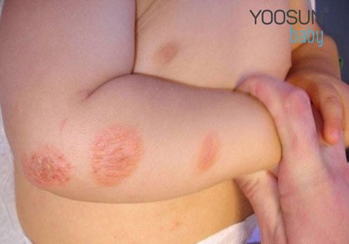 trẻ bị nổi mụn nước ở lòng bàn chân