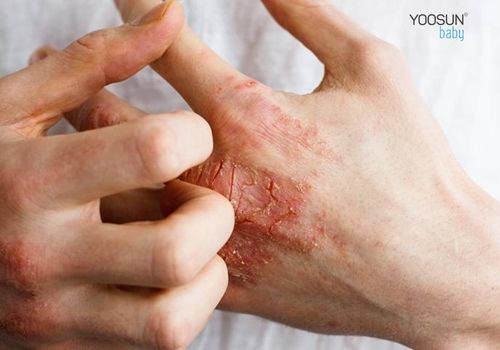 cách chữa dị ứng dầu máy