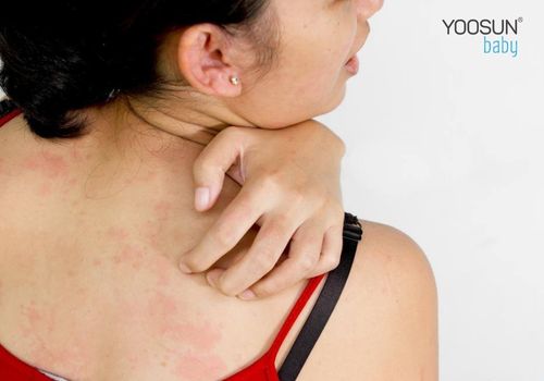 cách trị dị ứng kem body