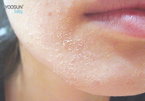 dị ứng cồn sát khuẩn