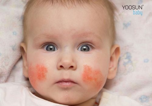 dị ứng da mặt mẩn đỏ ngứa
