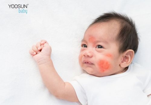 dị ứng thực phẩm và cách điều trị