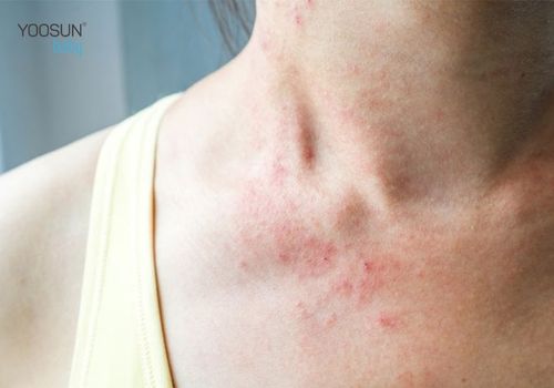làm gì khi bị dị ứng nước hoa